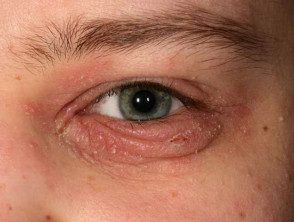 Blefaritis asociada con dermatitis atópica