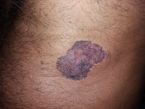 Carcinoma basocelular en piel de color.