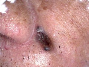 Carcinoma basocelular en piel de color.