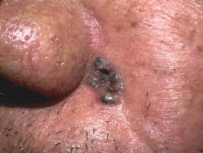 Carcinoma basocelular nodular