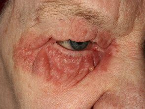 Blefaritis asociada con dermatitis seborreica