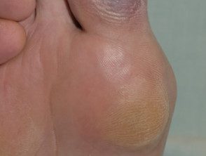 Síndrome de dedo azul: isquemia