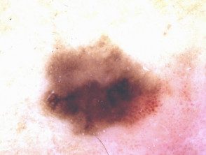 Dermatoscopia de carcinoma intraepidérmico pigmentado