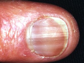 Pigmentación de uñas por hidroxiurea
