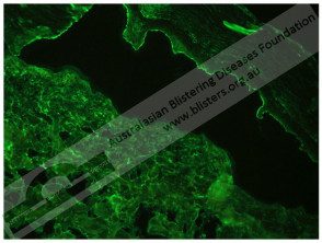 Inmunofluorescencia indirecta del penfigoide ampolloso