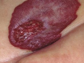 Hemangioma