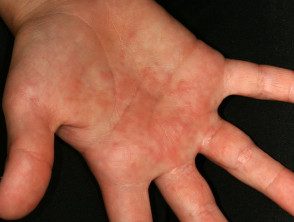 Irritación de las manos por contacto con orugas