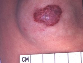 Hemangioma