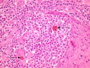 chromoblastomycosis-figure-4__protectwyjqcm90zwn0il0_focusfillwzi5ncwymjisingildfd-7811471-1797388