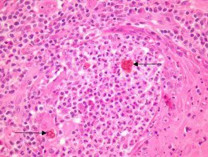 chromoblastomycosis-figure-4__protectwyjqcm90zwn0il0_focusfillwzi5ncwymjisingildfd-7811471-1797388