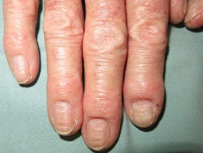 Dermatitis de la mano y paroniquia crónica.