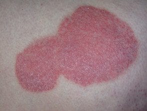 Images of chronic plaque psoriasis - Hoogstra - Centros Medicos