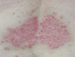 Psoriasis crónica en placa