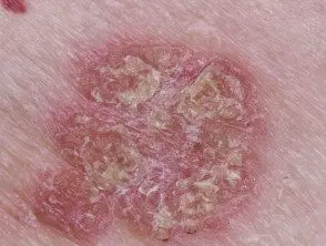 psoriasis-en-plaques-chronique-208__protectwyjqcm90zwn0il0_focusfillwzi5ncwymjisingilde5xq-8927482-5970854