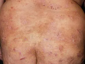 Rascado relacionado con dermatitis