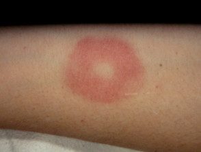 Urticaria inducida por hielo