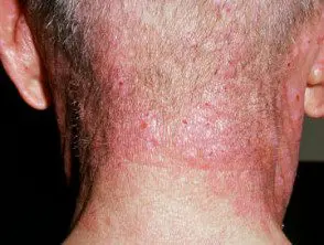 Alergia a las compuestas: dermatitis facial