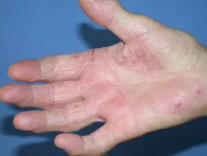 Alergia a las compuestas: dermatitis de mano