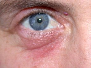 contact-dermatitis-eyelid-airborne__protectwyjqcm90zwn0il0_focusfillwzi5ncwymjisinkildg1xq-4216046-6050112