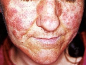 Comment soulager une allergie cosmétique ?