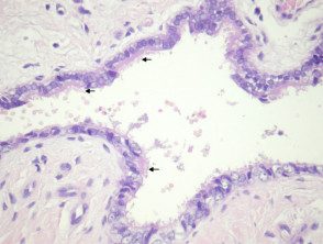 cutaneous-ciliated-cyst-figure-4__protectwyjqcm90zwn0il0_focusfillwzi5ncwymjisingildfd-1273058-3199308