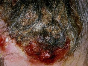 cutaneous-hodgkin-002__protectwyjqcm90zwn0il0_focusfillwzi5ncwymjisingildfd-2577386-8705520