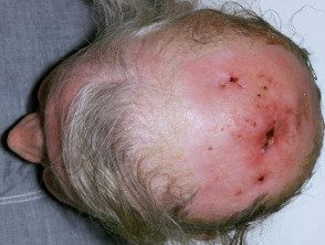 cutaneous-hodgkin-003__protectwyjqcm90zwn0il0_focusfillwzi5ncwymjisingildfd-9207965-1198214