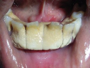 dental-plaque__protectwyjqcm90zwn0il0_focusfillwzi5ncwymjisingildfd-4549697-9814598