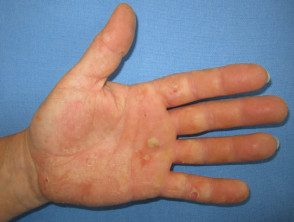 Dermatitis de la mano por alergia a los guantes de goma.