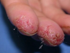 Dermatitis de la mano