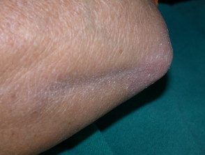 Dermatomiositis del brazo. 