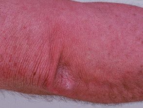 Dermatomiositis del brazo. 