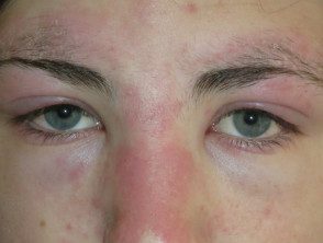 dermatomyositis-eyelids-4__protectwyjqcm90zwn0il0_focusfillwzi5ncwymjisingildiwxq-1882605-2310974
