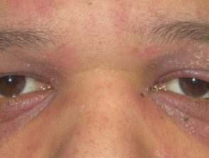 dermatomyositis-eyelids-5__protectwyjqcm90zwn0il0_focusfillwzi5ncwymjisingildk4xq-3732827-7082271