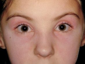 dermatomyositis-eyelids-7__protectwyjqcm90zwn0il0_focusfillwzi5ncwymjisingildfd-6445957-4205708