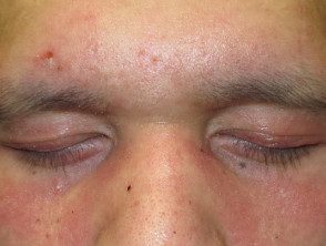 dermatomyositis-eyelids-9__protectwyjqcm90zwn0il0_focusfillwzi5ncwymjisingildi4xq-9500414-6764752