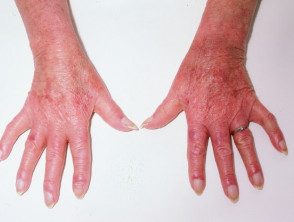 Dermatomiositis de la mano. 