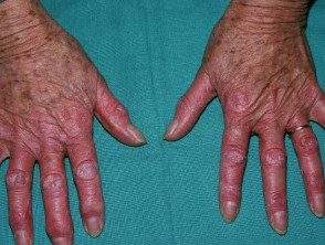 Dermatomiositis de la mano. 