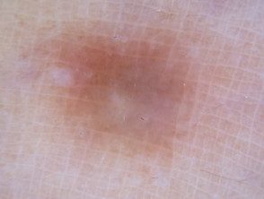 Dermatoscopia Pigmentación blanda y sin estructura: dermatofibroma