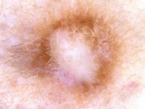 Dermatoscopia Área blanca central prominente: dermatofibroma