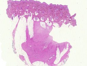 desmoplastic-fibroblastoma-figure-1__protectwyjqcm90zwn0il0_focusfillwzi5ncwymjisinkildezxq-1635152-4567818