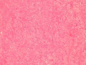 desmoplastic-fibroblastoma-figure-2__protectwyjqcm90zwn0il0_focusfillwzi5ncwymjisingildfd-4174699-9236639