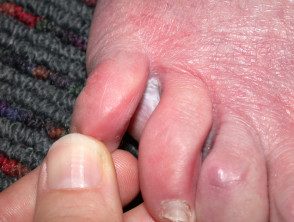 Úlcera del pie diabético