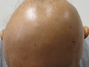 Alopecia universal