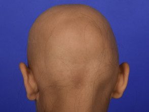 Alopecia total