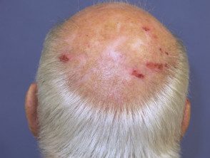diffuse-alopecia-05__protectwyjqcm90zwn0il0_focusfillwzi5ncwymjisingildfd-2776535-7202130
