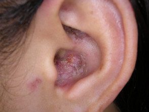 Lupus eritematoso discoide crónico 