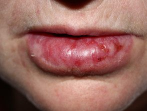 Lupus eritematoso discoide crónico en los labios