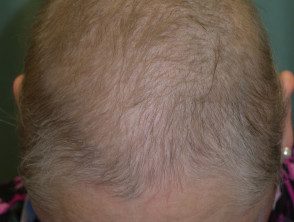 Alopecia inducida por fármacos