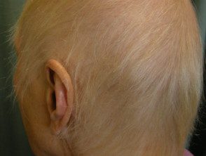 alopecia-droga1__protectwyjqcm90zwn0il0_focusfillwzi5ncwymjisinkildg1xq-4045623-9525300
